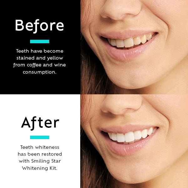 TEETH WHITENING KIT WITH LED LIGHT